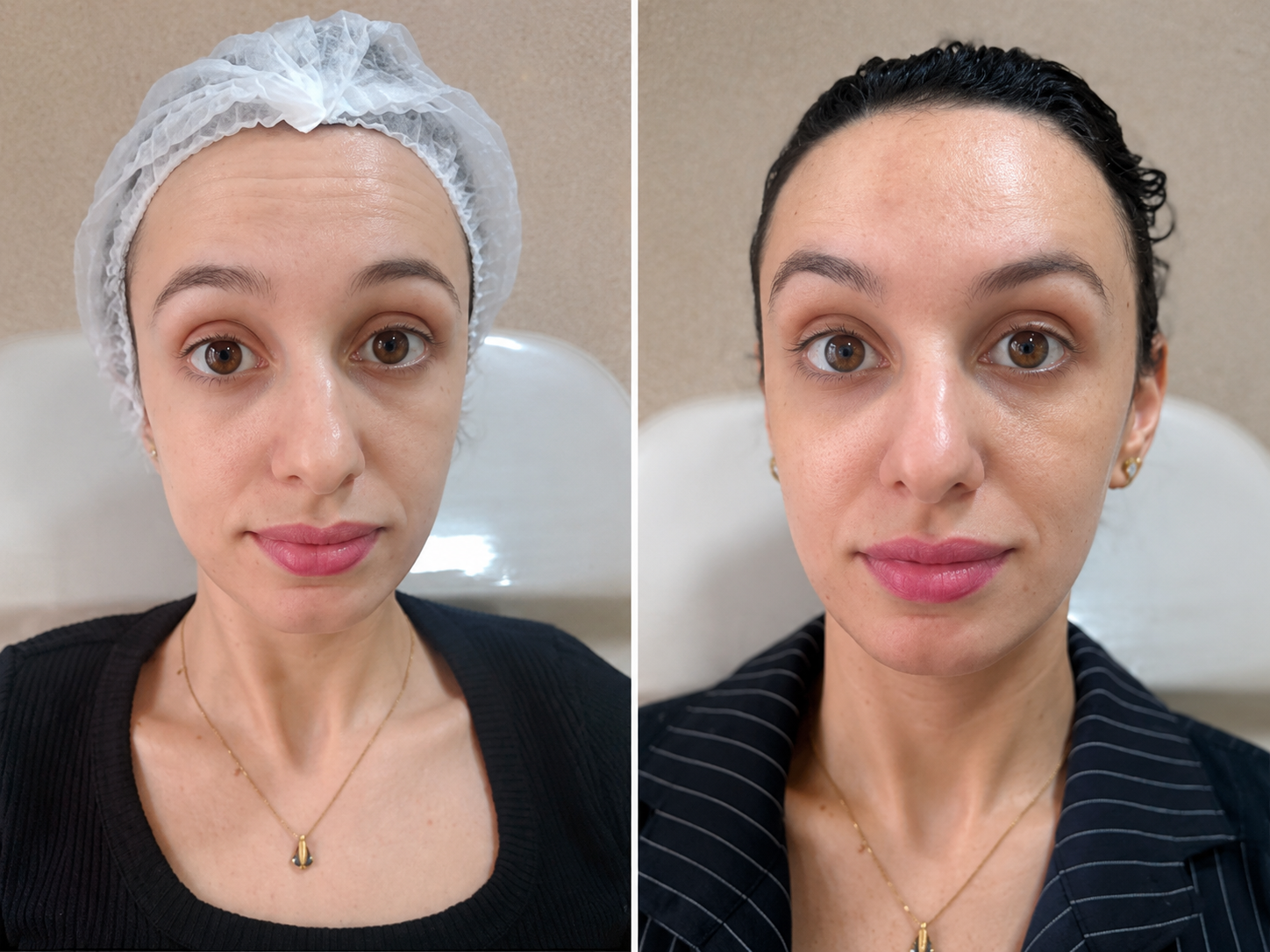 Botox